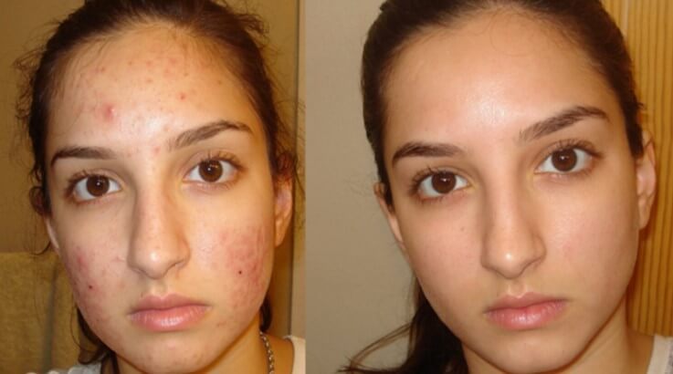 Imodstyle Rid Acne Quickly