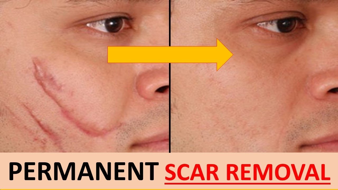 Imodstyle Remove Scar Guide
